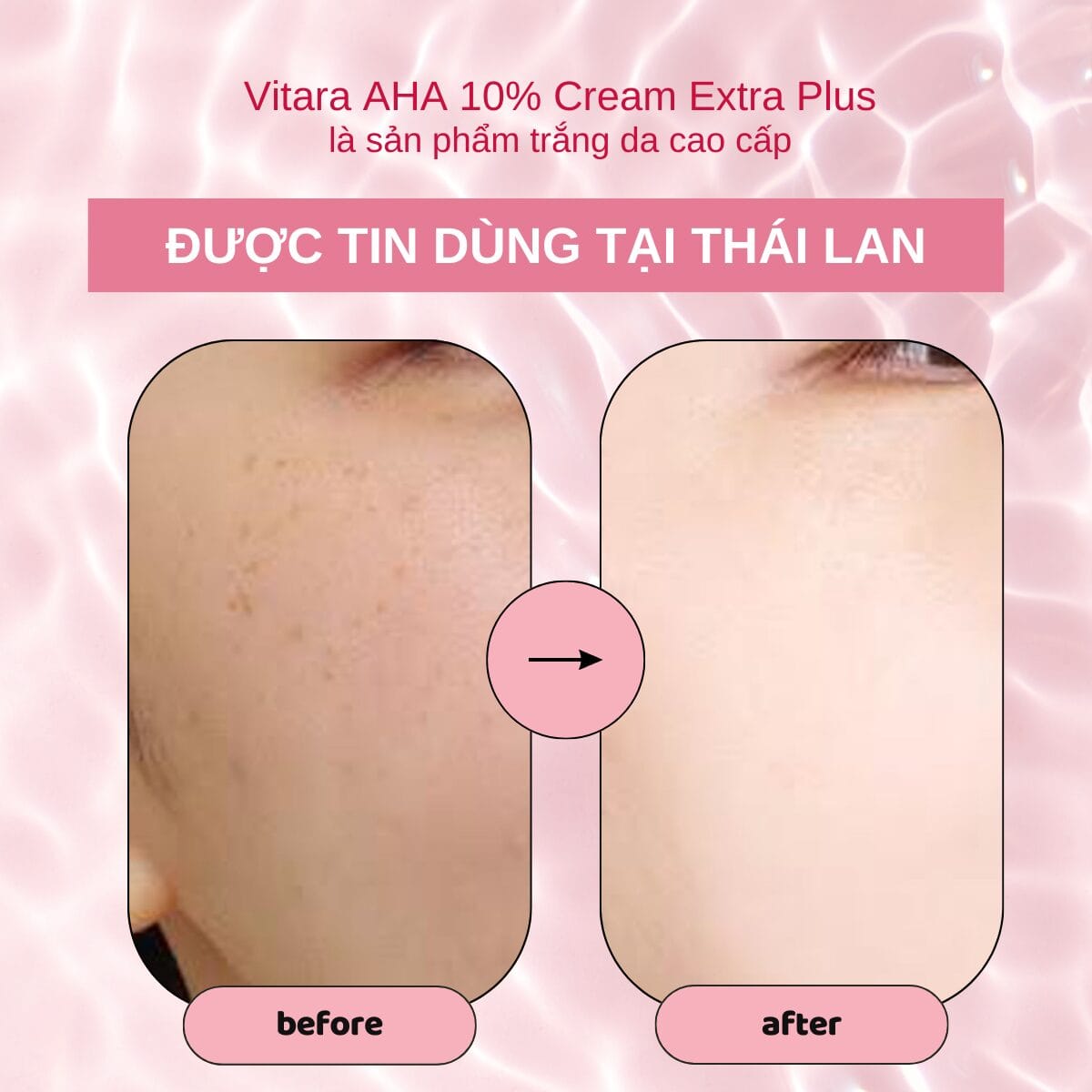 VITARA AHA 10% CREAM PLUS GLUTATHIONE 20 g. ไวทาร่า เอเอชเอ ครีม กลูต้า เผยผิวขาว ลดเลือนฝ้า